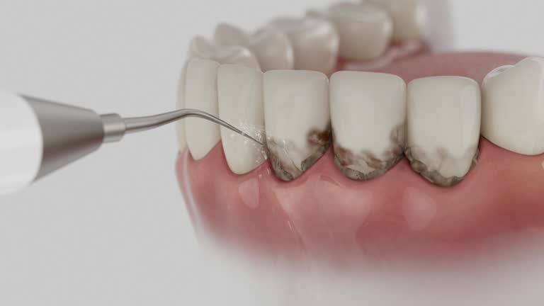 Trusted Wisdom Tooth Removal service in Odon, IN - Dentist Open Now